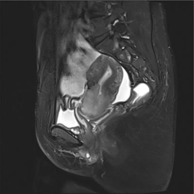 Gastric-type mucinous endocervical adenocarcinomas: A case report and literature review